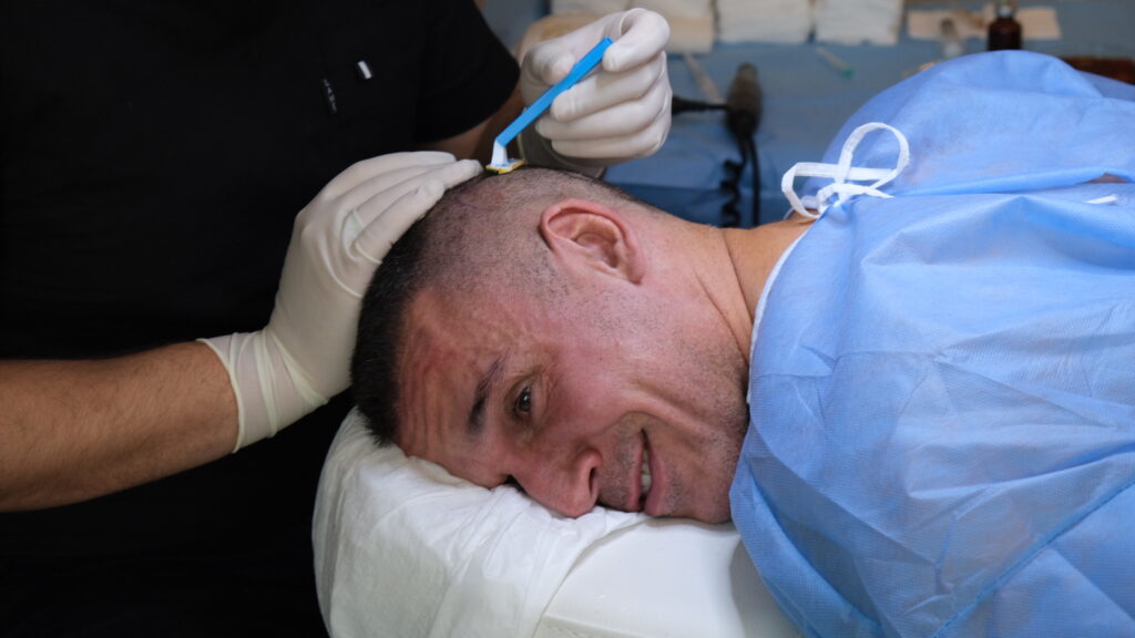 Hair Transplant Repair