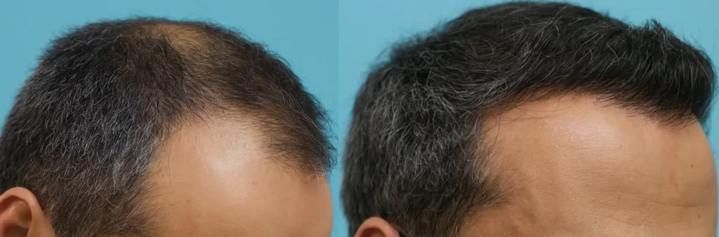Hair Transplant Cost in Turkey (2026 Guide)