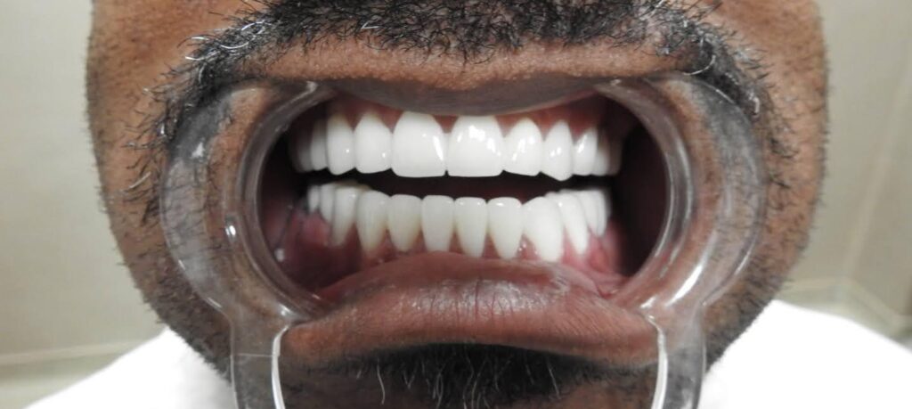 Dental Treatments in Turkey