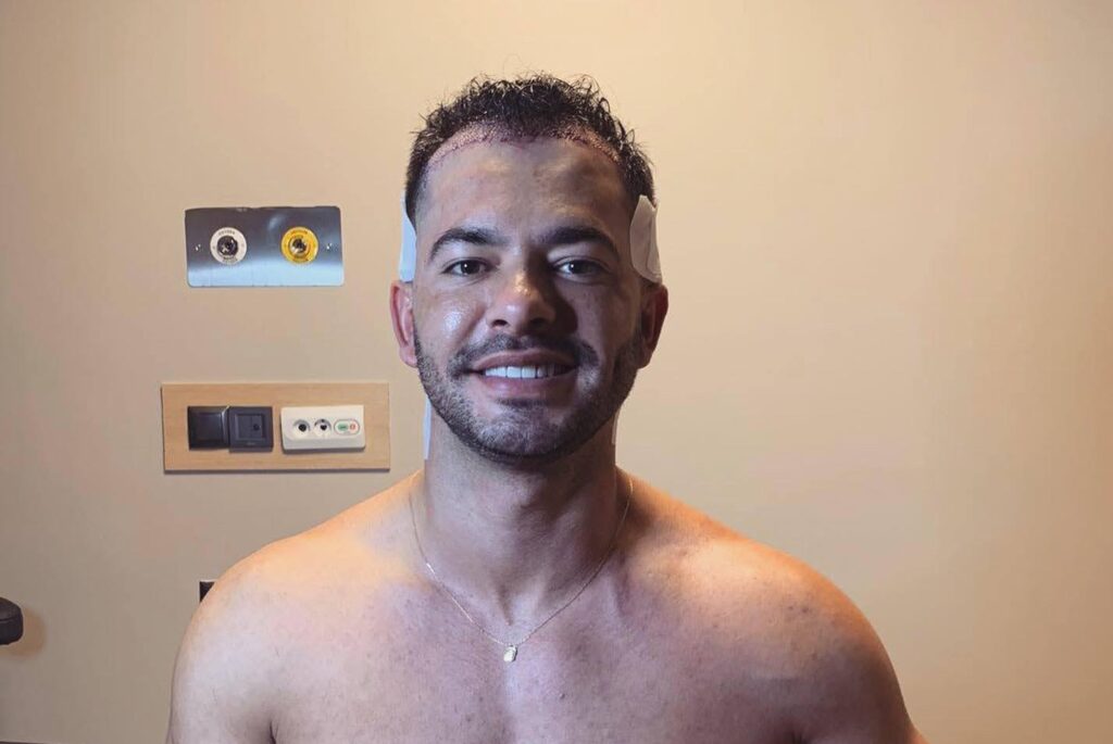 Hair Restoration in Turkey