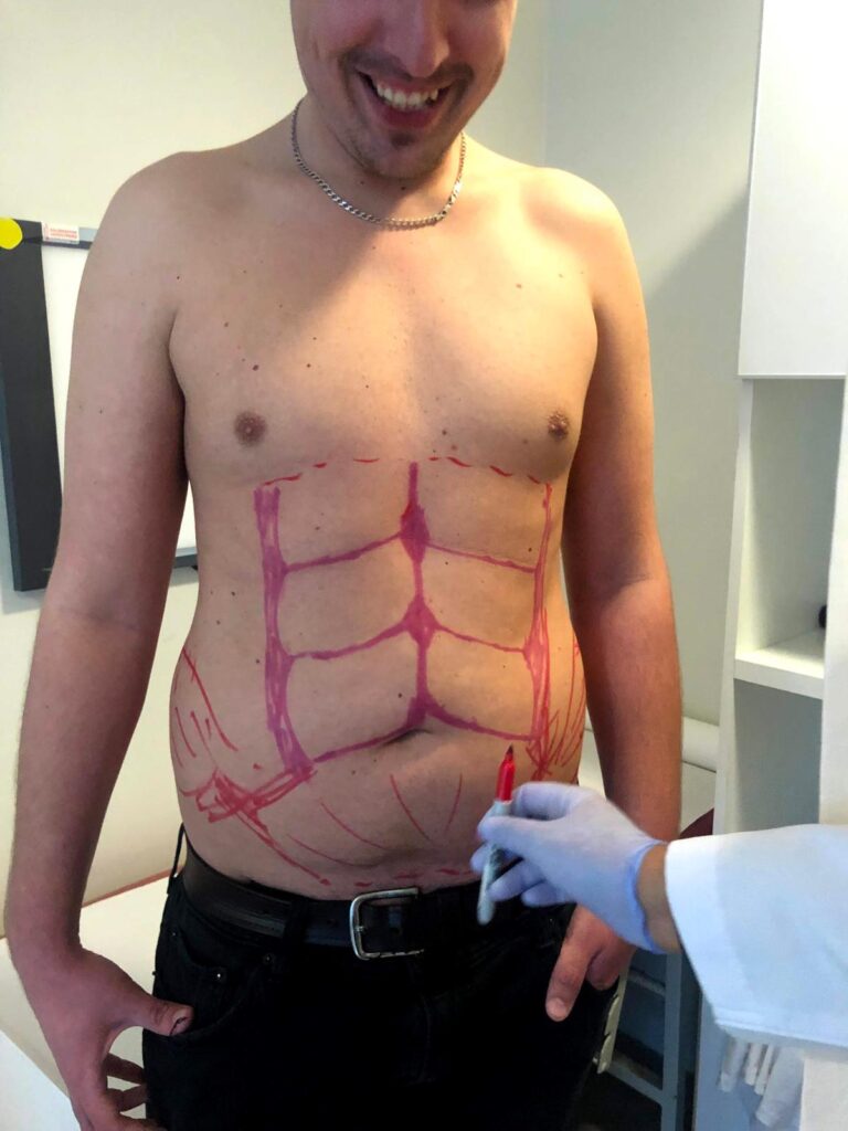 Six Pack Surgery