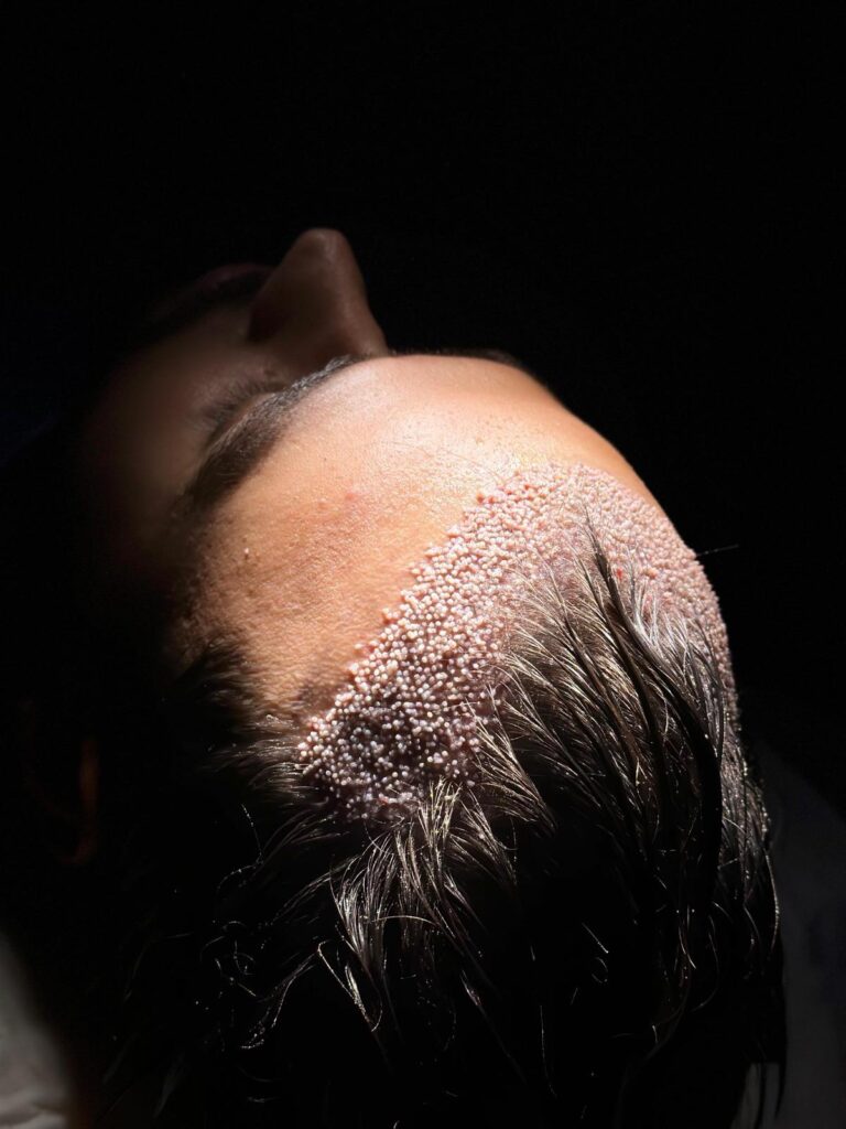DHI Hair Transplant