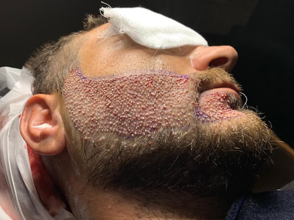 Beard Transplant