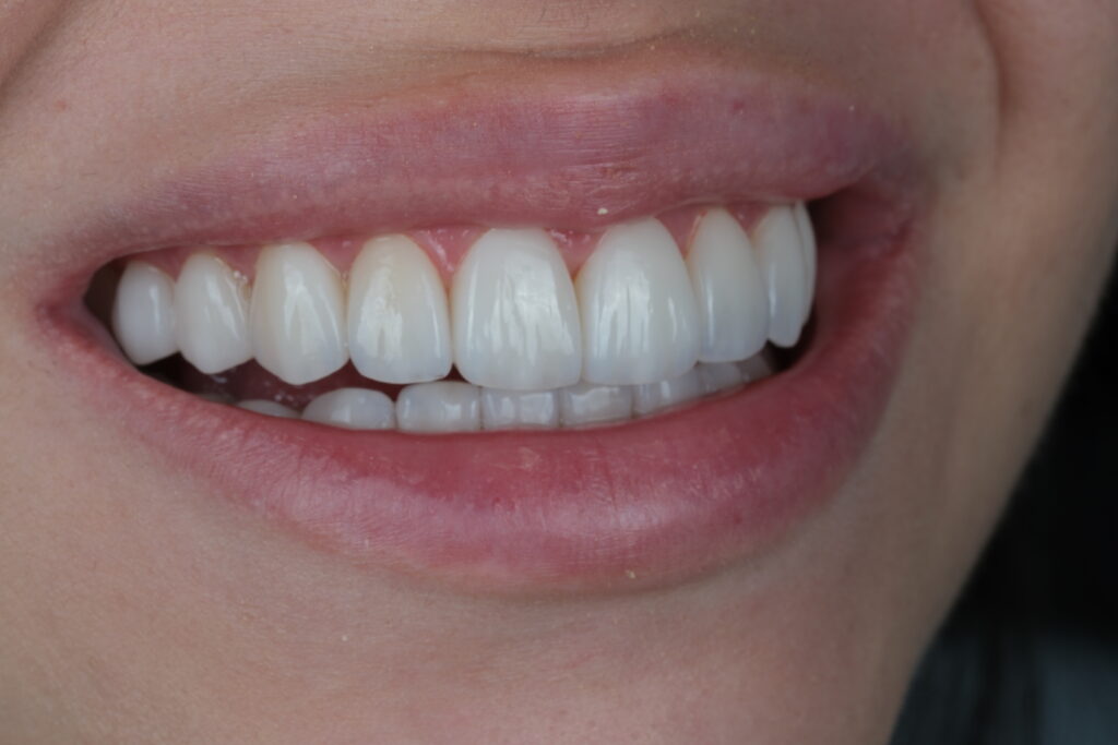 Dental Veneers