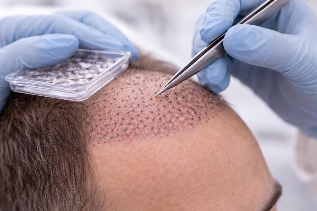 Hair Transplant Sapphire FUE